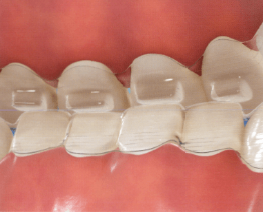 INVISALIGN G5