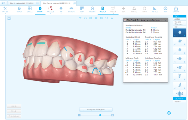 invisalign