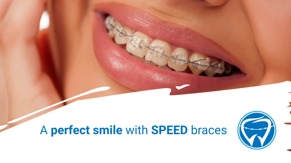 A perfect smile with SPEED braces