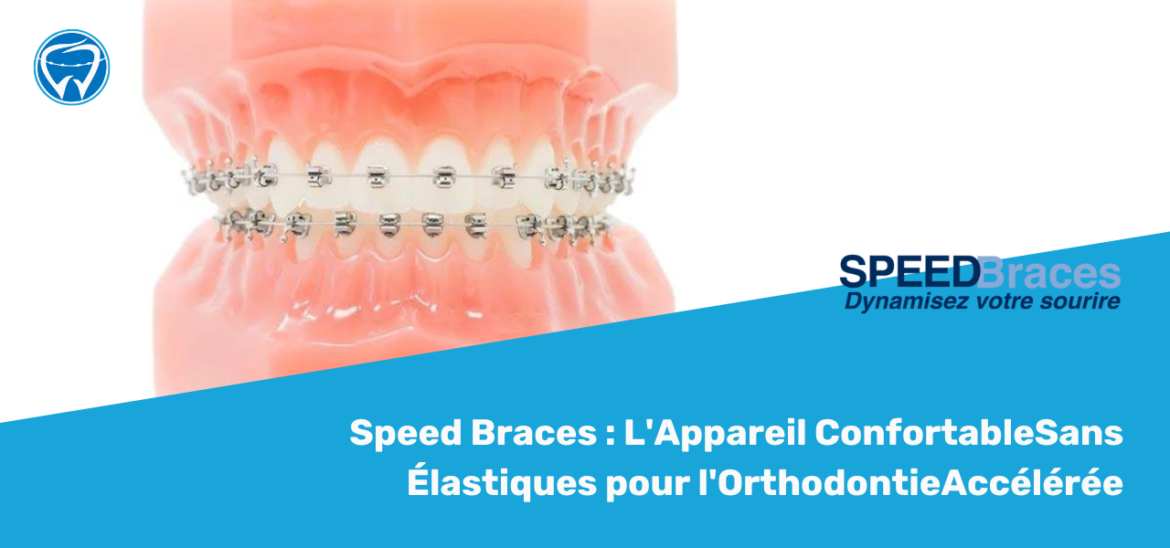 Speed Braces : L'Appareil ConfortableSans Élastiques pour l'OrthodontieAccélérée
