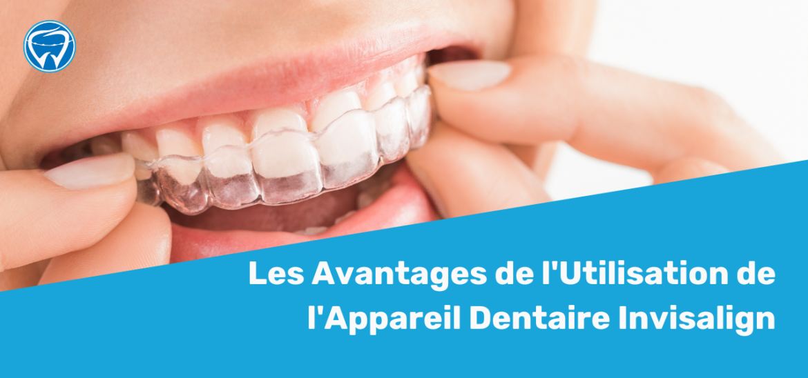 Les Avantages de l'Utilisation de l'Appareil Dentaire Invisalign